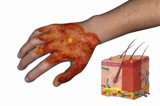 Burns Hand Surgery Resource 6088